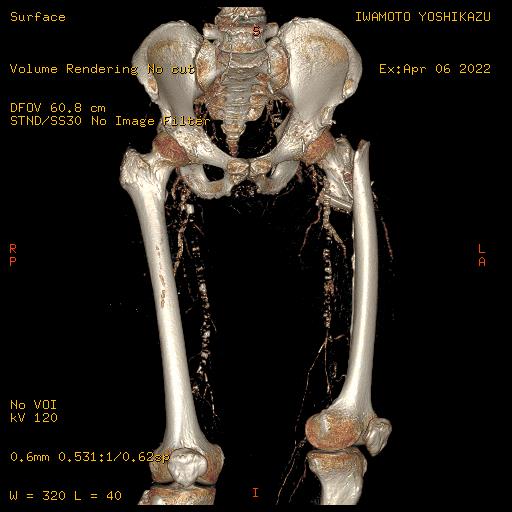 MRI